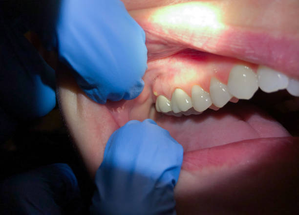 Best Emergency Broken Tooth Repair in Cayuga, IN