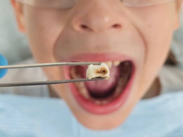 Best Emergency Treatment for Toothache in Cayuga, IN
